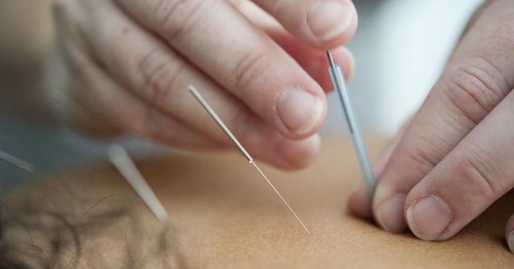 4 Core Reasons Why Acupuncture is Necessary